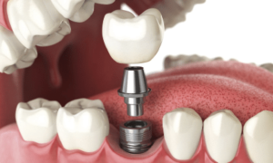 Read more about the article Can it be Really Cheaper to Have Dental Implants Overseas?